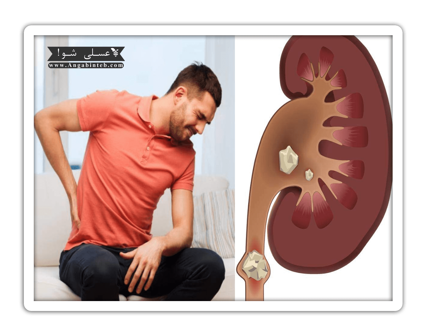 Tea consumption in kidney stone disease-5-min.png